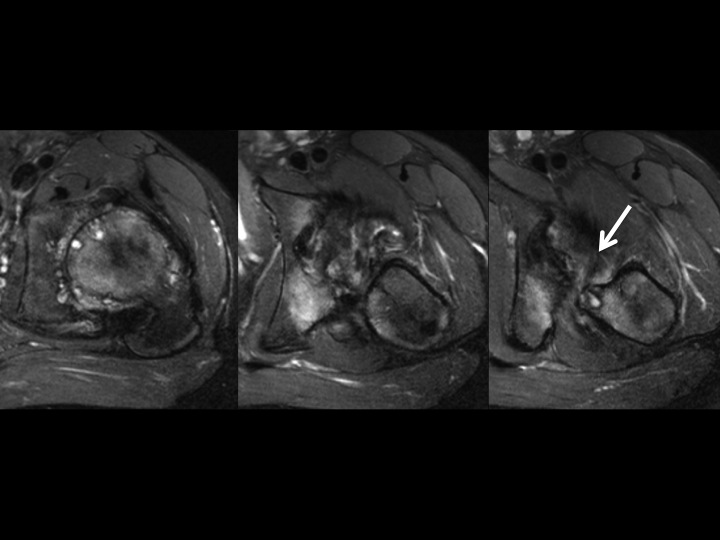 Figure 3 for case acetabular-femoral impingement